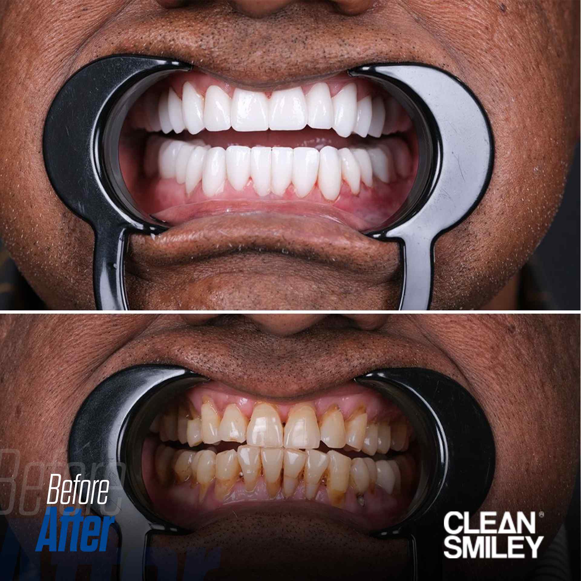 Hollywood Smile Türkiye Öncesi ve Sonrası