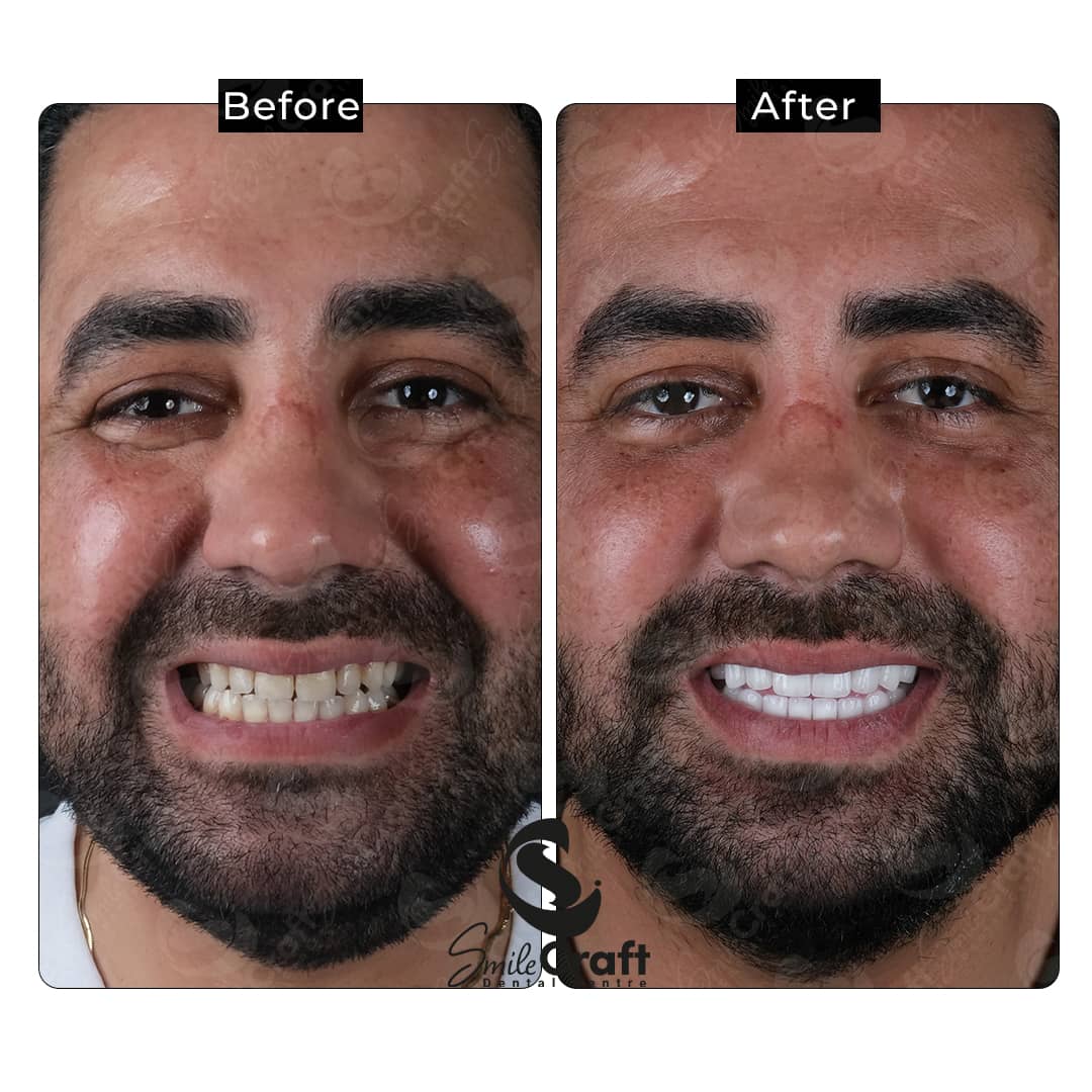 Emax veneer uygulaması öncesi ve sonrası