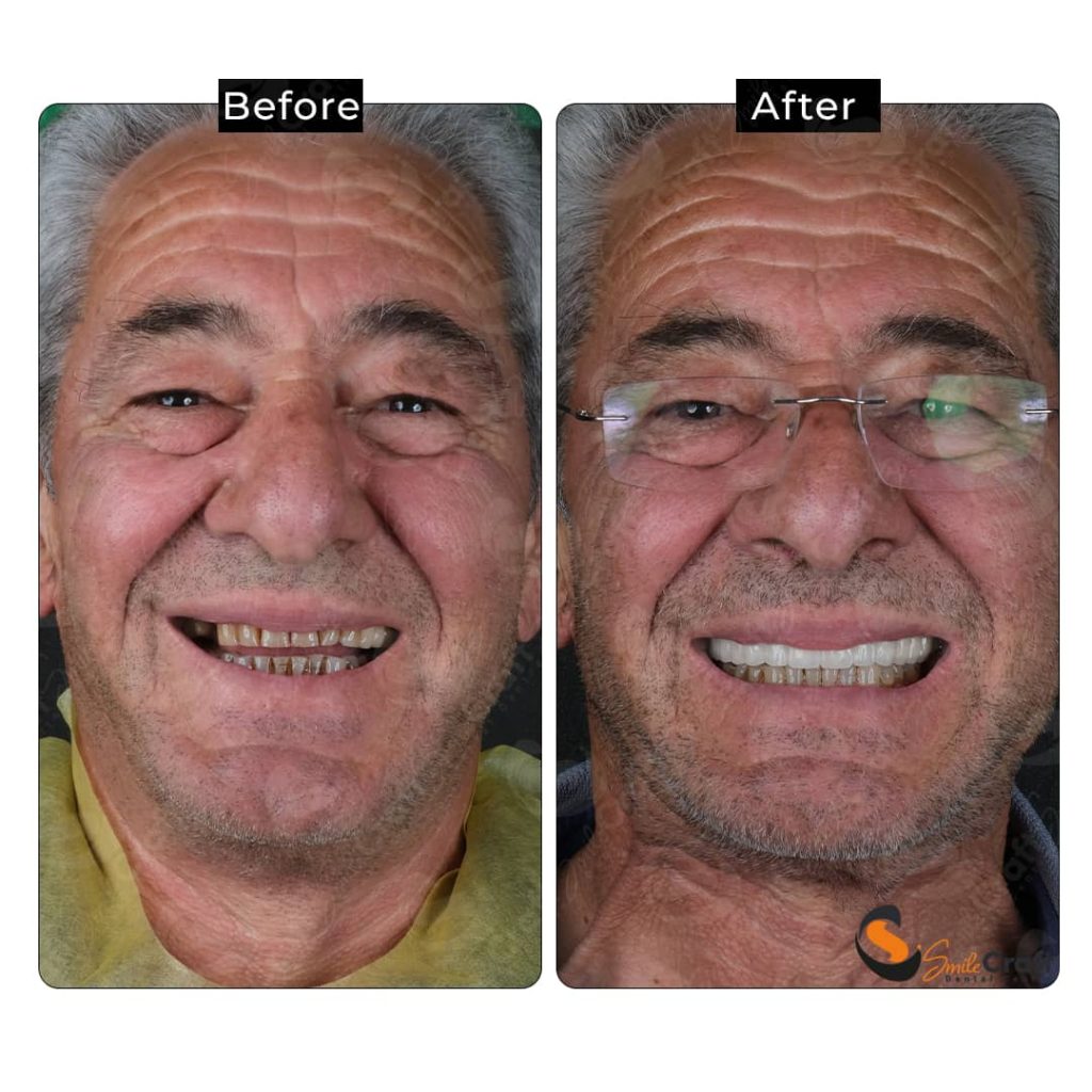 All-on-6 implant tedavisi öncesi ve sonrası