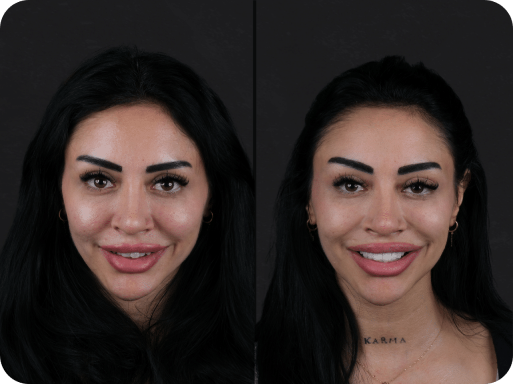 Smile Craft tedavisi öncesi ve sonrası gülüş