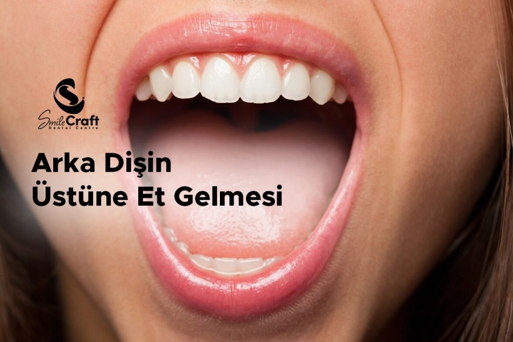 Arka Dişin Üstüne Et Gelmesi