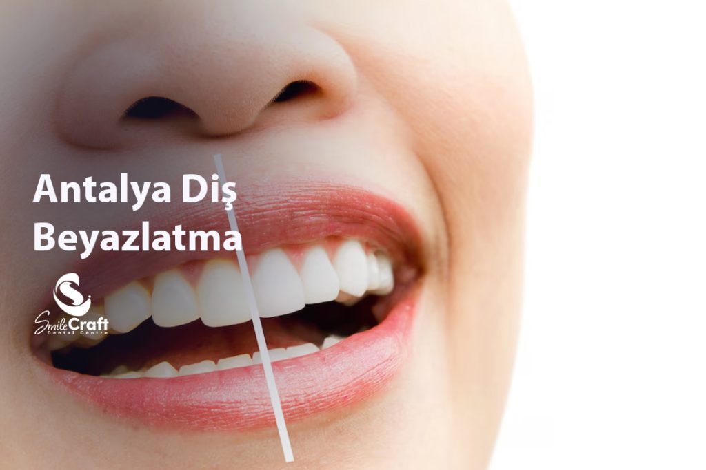 Antalya Diş Beyazlatma