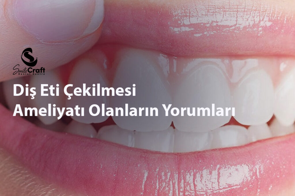 Diş Eti Çekilmesi Ameliyatı Olanların Yorumları