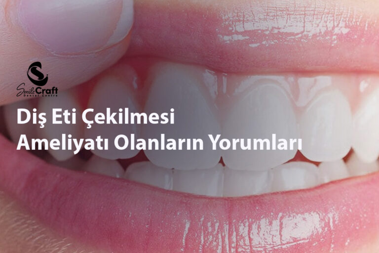 Diş Eti Çekilmesi Ameliyatı Olanların Yorumları