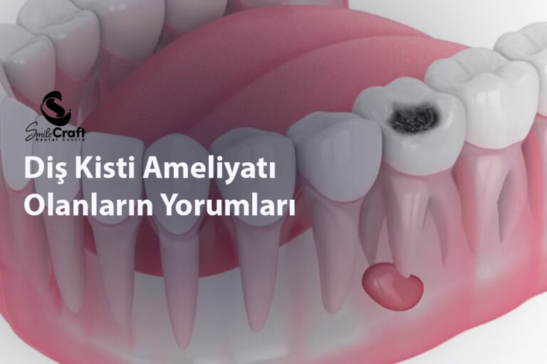 Diş Kisti Ameliyatı Olanların Yorumları