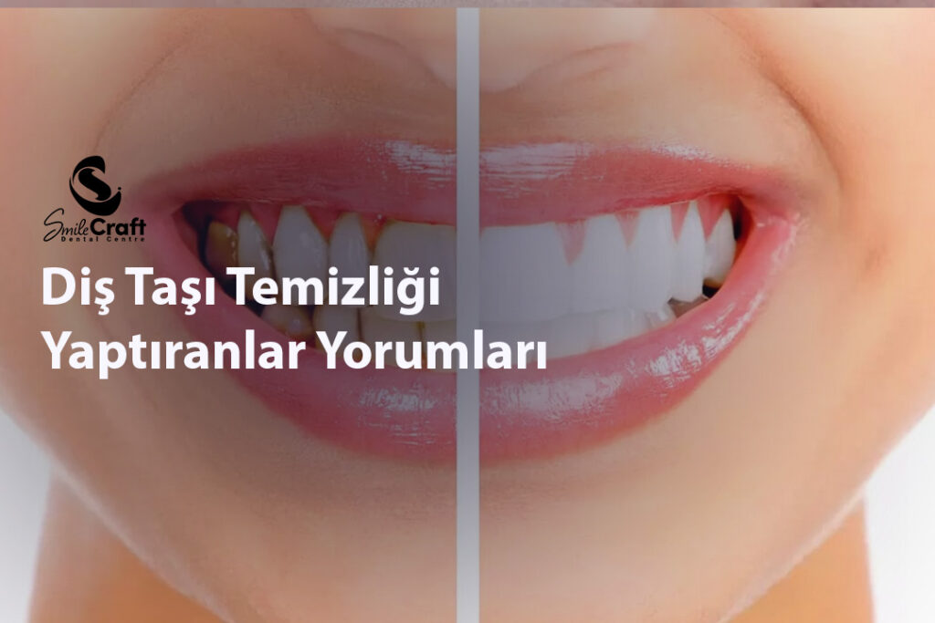 Diş Taşı Temizliği Yaptıranlar Yorumları