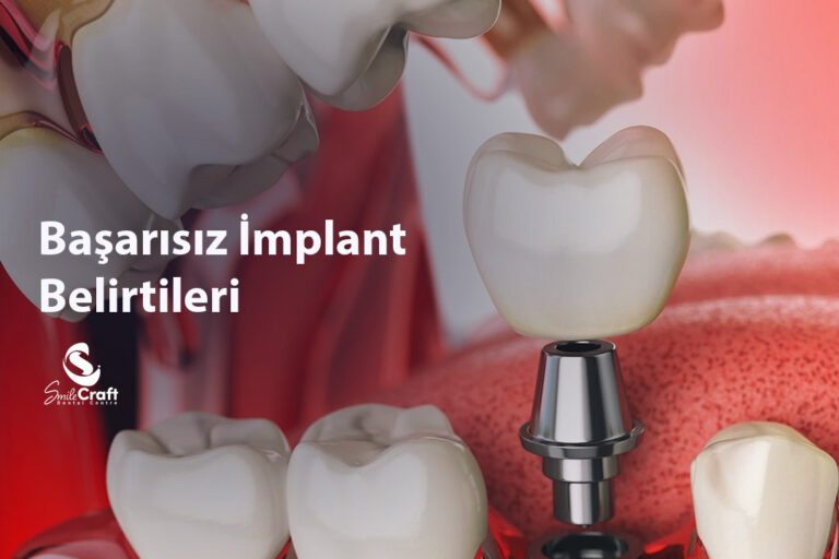 Başarısız İmplant Belirtileri