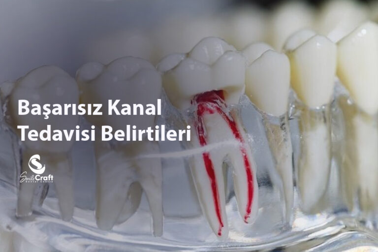 Başarısız Kanal Tedavisi Belirtileri