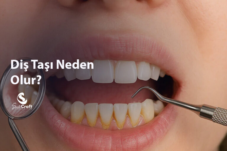 Diş Taşı Neden Olur
