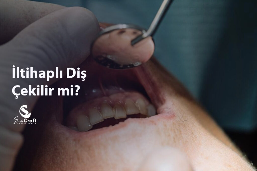 İltihaplı Diş Çekilir mi?
