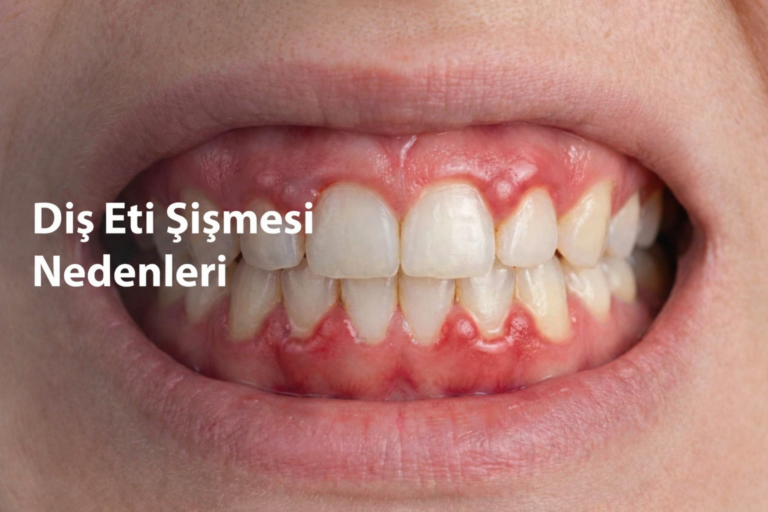 Diş eti şişmesine yol açan başlıca nedenler