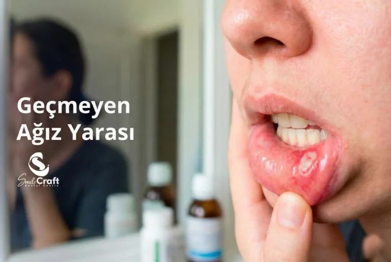 Geçmeyen Ağız Yarası